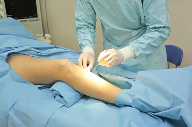 Flebectomy
