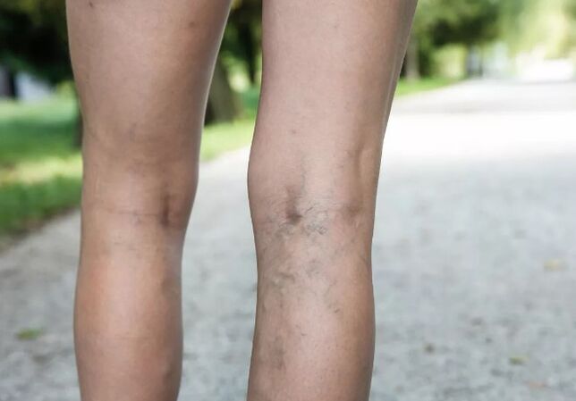 Varicose veins