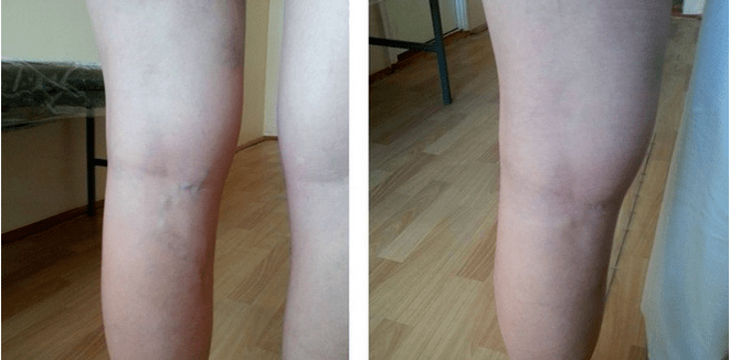 varicose veins on the feet