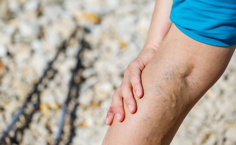 Varicose veins in the feet